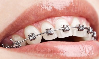 diş teli tedavisi